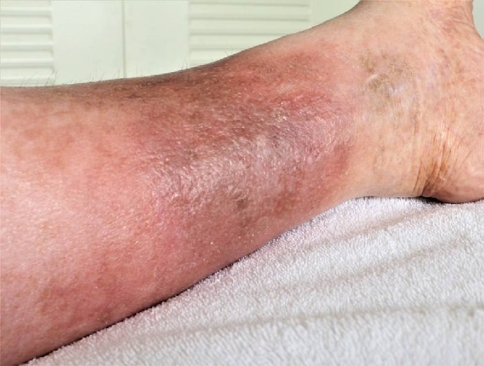 Living with Leg Scars: Navigating the Physical and Emotional Effects